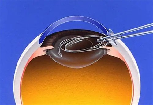 烏魯木齊普瑞眼科蔣國安做白內(nèi)障手術(shù)費(fèi)用5000元起，術(shù)后視力成效佳