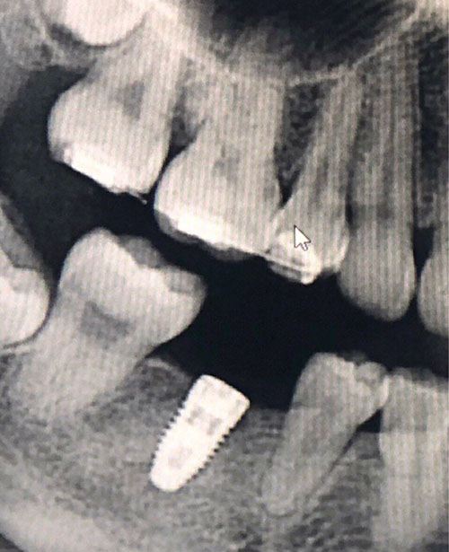 紹興國興口腔醫(yī)院種植牙