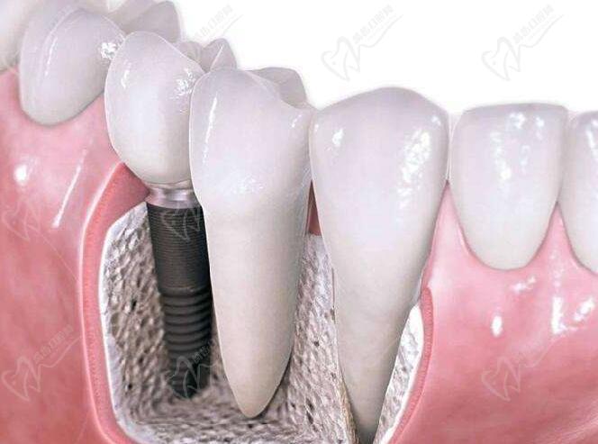 平頂山博華口腔劉向華種牙怎么樣