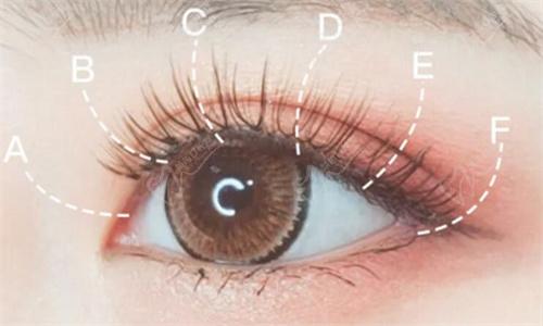 譚琳醫(yī)生修復(fù)雙眼皮技術(shù)好