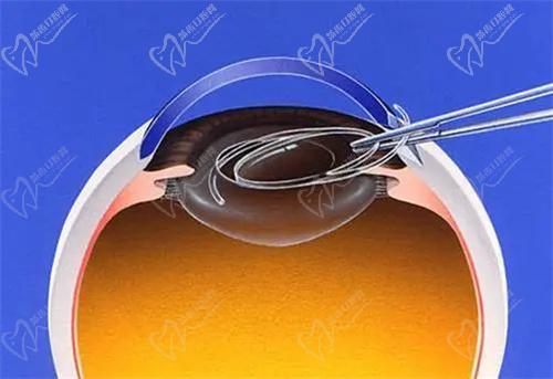 烏魯木齊普瑞眼科醫(yī)院白內(nèi)障手術(shù)費(fèi)用