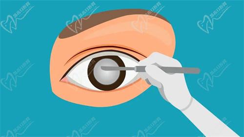 白內(nèi)障手術(shù)費(fèi)用受哪些因素影響