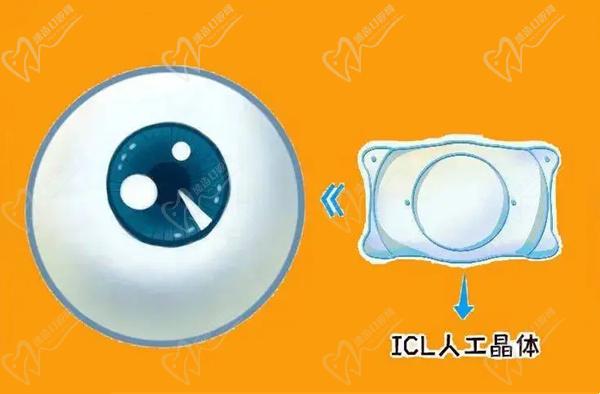 人工晶體植入