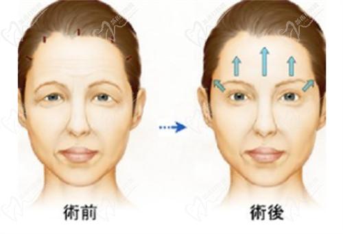 武漢藝星半島超聲炮抗衰怎么樣