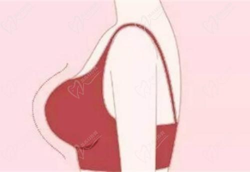 武漢同 濟醫(yī)院葉子榮曼托假體隆胸技術(shù)嫻熟