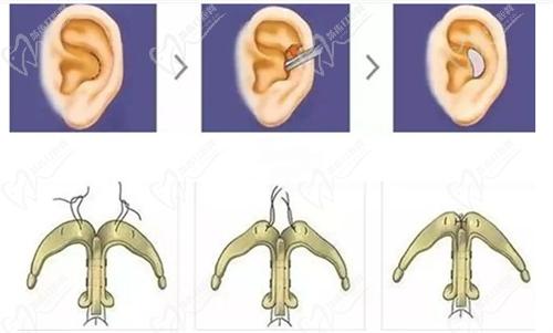 武漢藝星整形楊國梁耳軟骨復(fù)合隆鼻手術(shù)技術(shù)嫻熟