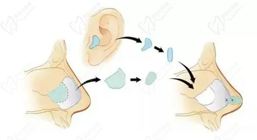 武漢藝星整形楊國梁耳軟骨復(fù)合隆鼻手術(shù)備受稱贊