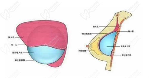 徐國建醫(yī)生做曼托圓盤光面假體隆胸技術(shù)出色