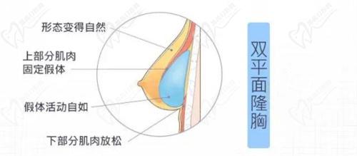 武漢藝星整形醫(yī)院的曼托圓盤光面假體隆胸價格