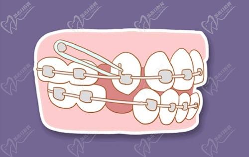 潘牛兵正畸醫(yī)術怎么樣啊