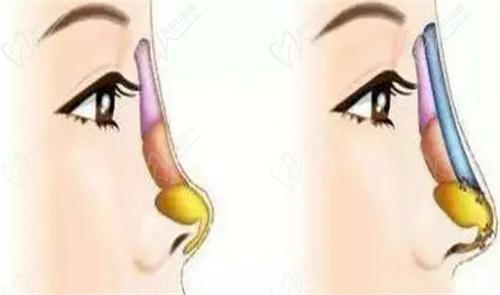 武漢同 濟(jì)吳輝醫(yī)生做鼻子的技術(shù)不錯(cuò)