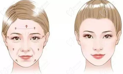 杭州薇琳馮志丹醫(yī)生做面部脂肪填充怎么樣？