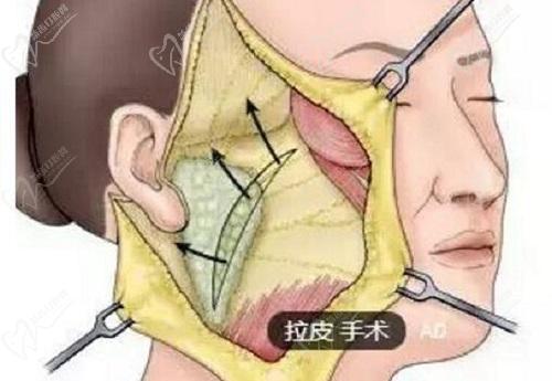 拉皮手術(shù)哪里的整容醫(yī)院做的好？