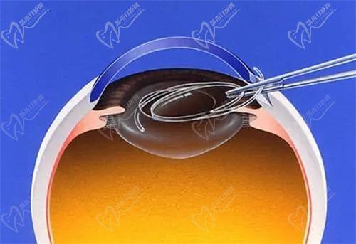 烏魯木齊普瑞眼科蔣國安做白內(nèi)障手術(shù)費(fèi)用5000元起，術(shù)后視力成效佳