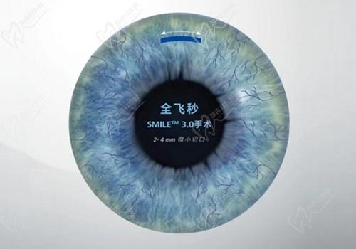 烏魯木齊普瑞眼科醫(yī)院全飛秒價(jià)格18800元起，視力高清視覺優(yōu)越