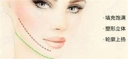 杭州薇琳馮志丹醫(yī)生做面部脂肪填充價(jià)格19800起，改善凹陷臉及細(xì)紋更顯幼態(tài)